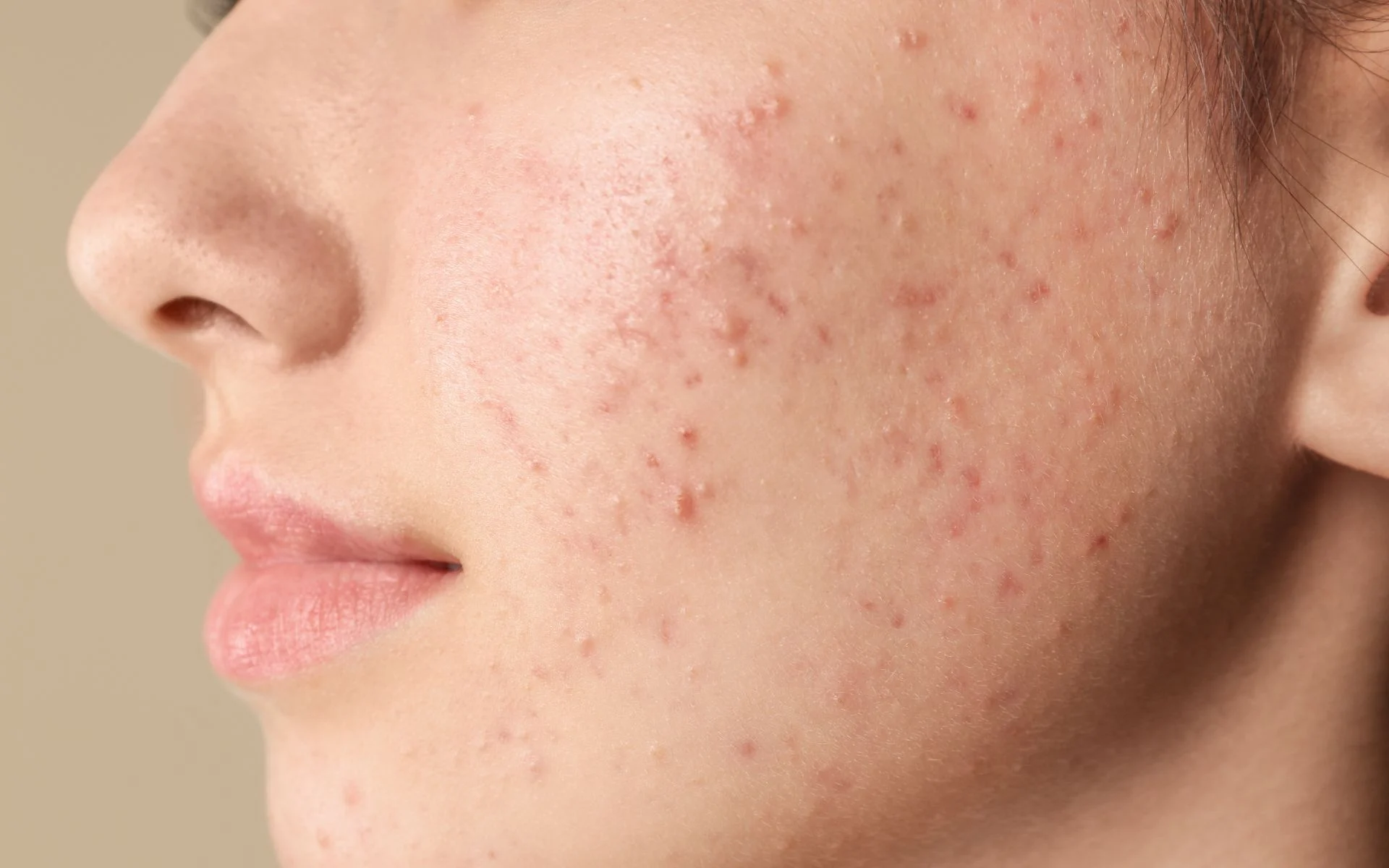 Acne adulta